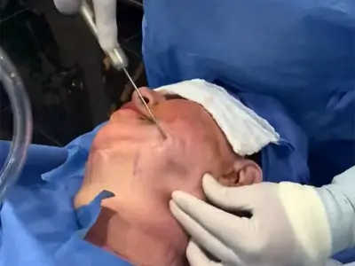 Tighten your Lower Face and Neck with FaceTite