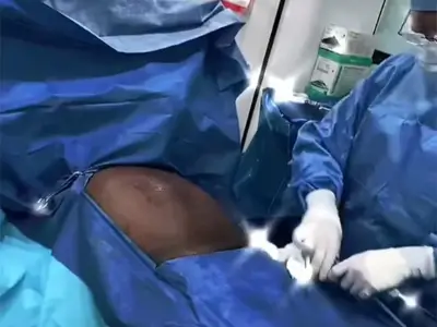Hi Def Liposuction - Videos