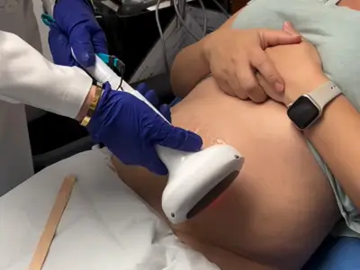 Lumecca IPL Treatment