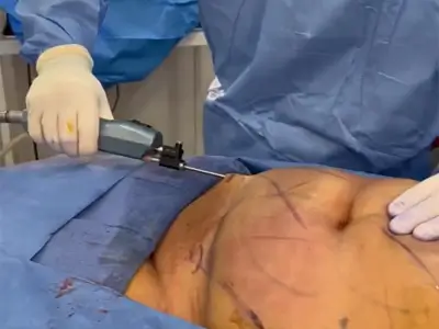 VASER Liposuction for Abdomen Contouring