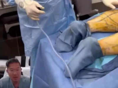 Calf and Ankle Liposuction