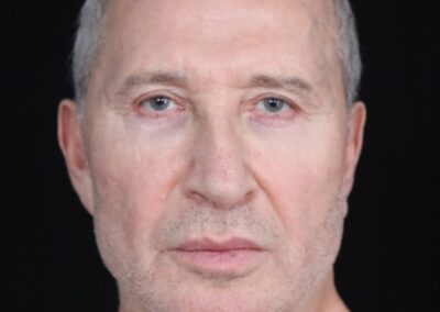 Male face lift before - front view