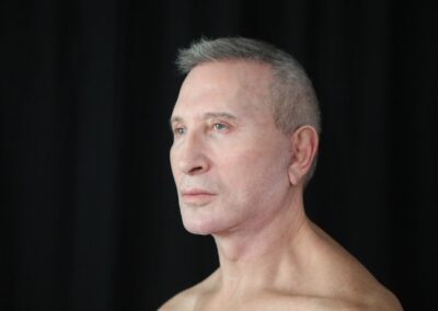 Male face lift after - oblique view