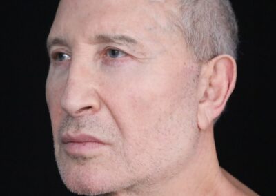 Male face lift before - oblique view