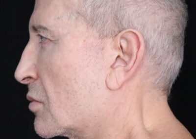 Male face lift before - side view