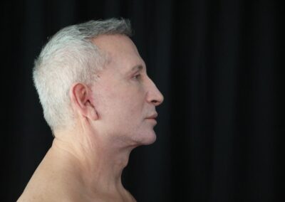 Male face lift after - profile view