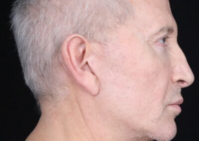 Male face lift before - profile view