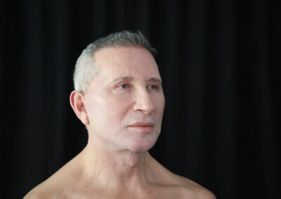 Male face lift after - rear oblique view