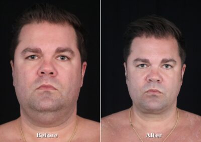 Male NeckTite before and after - patient 2, view 1