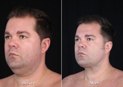 Male NeckTite before and after - patient 2, view 2