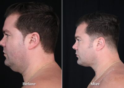 Male NeckTite before and after - patient 2, view 3