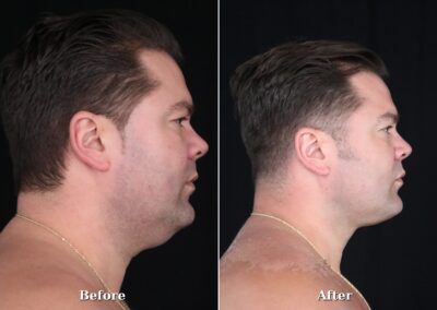 Male NeckTite before and after - patient 2, view 4