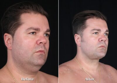 Male NeckTite before and after - patient 2, view 5