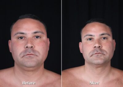 Male NeckTite before and after - patient 1, view 1
