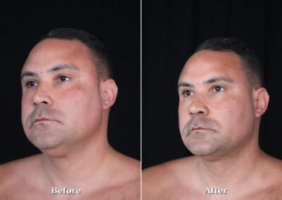 Male NeckTite before and after - patient 1, view 2