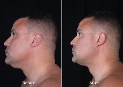 Male NeckTite before and after - patient 1, view 3