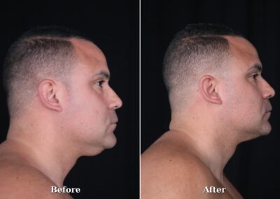 Male NeckTite before and after - patient 1, view 4