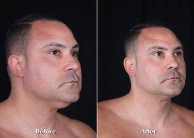 Male NeckTite before and after - patient 1, view 5