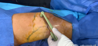 bodyTite Knee Liposuction