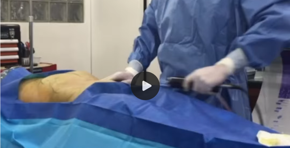 Brazilian Butt Lift Surgery Video: Patient 5