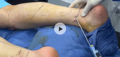 Calf Liposuction with BodyTite in NYC